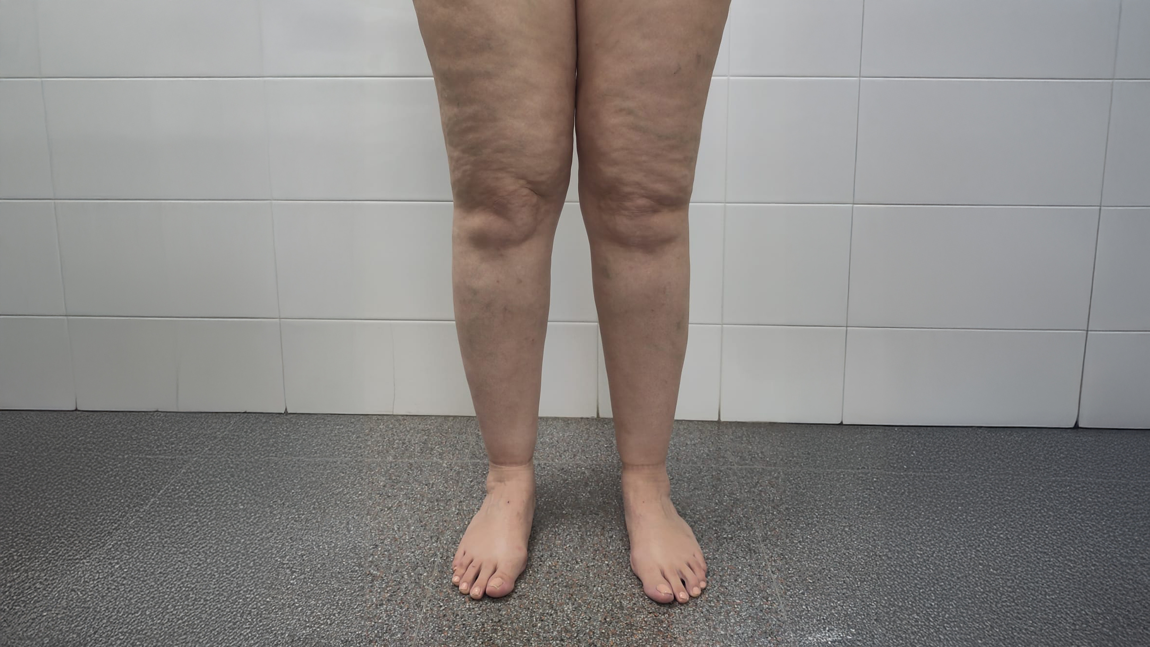 Lipedema